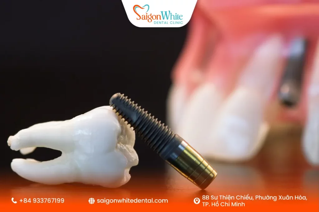 Cách tính chi phí trồng răng Implant chi tiết