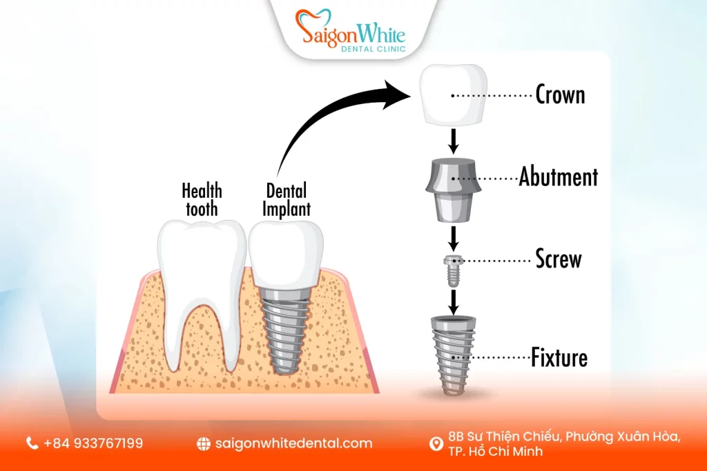 Cấu tạo của một trụ Implant tiêu chuẩn