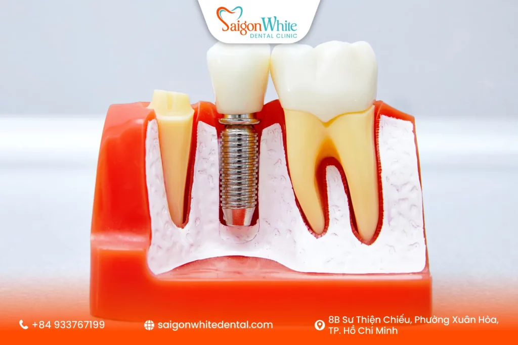 Trụ Implant là gì?