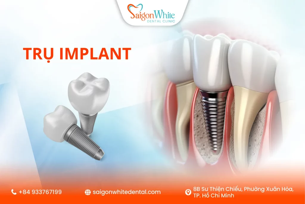 Cấu Tạo Trụ Implant Gồm Những Gì?