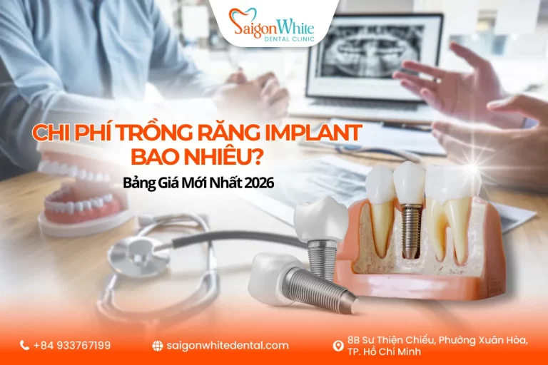 Chi Phí Trồng Răng Implant Bao Nhiêu? Bảng Giá Mới Nhất 2026