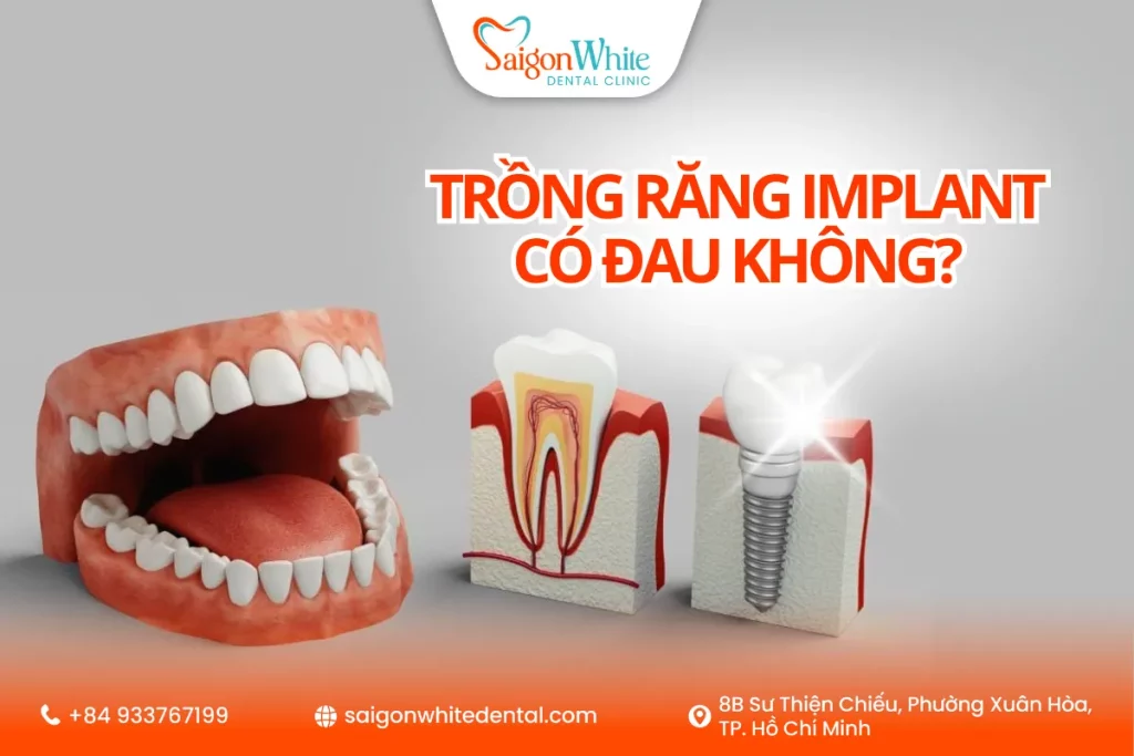 Trồng răng implant có đau không?