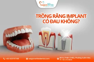 Trồng răng implant có đau không?