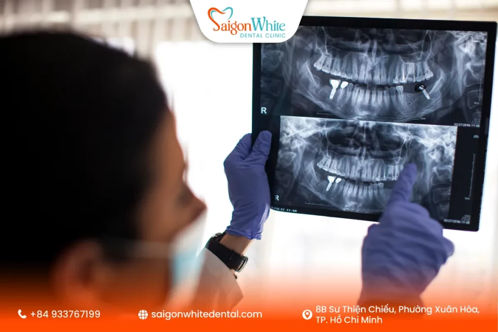 Yếu tố ảnh hưởng đến chi phí trồng răng Implant
