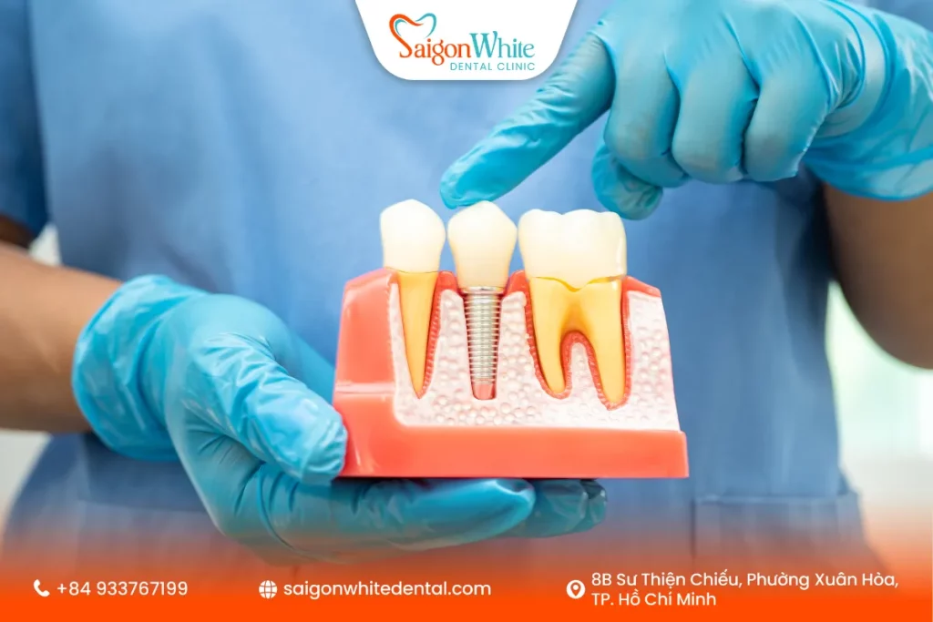 Yếu tố dẫn đau khi cấy ghép implant