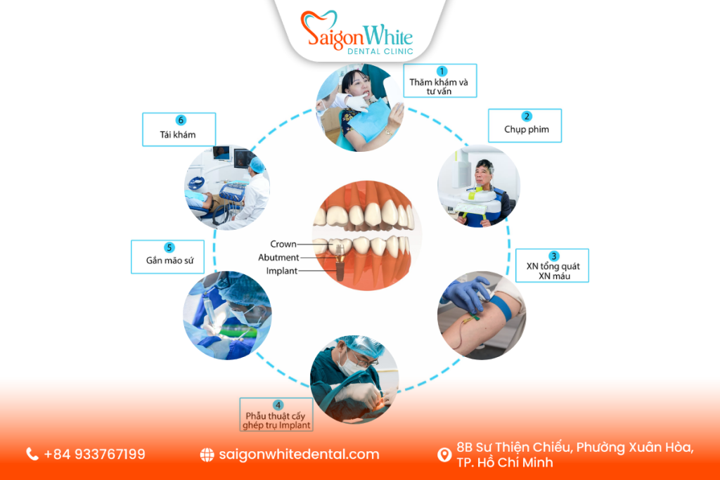 Giai đoạn trồng răng implant tại nha khoa