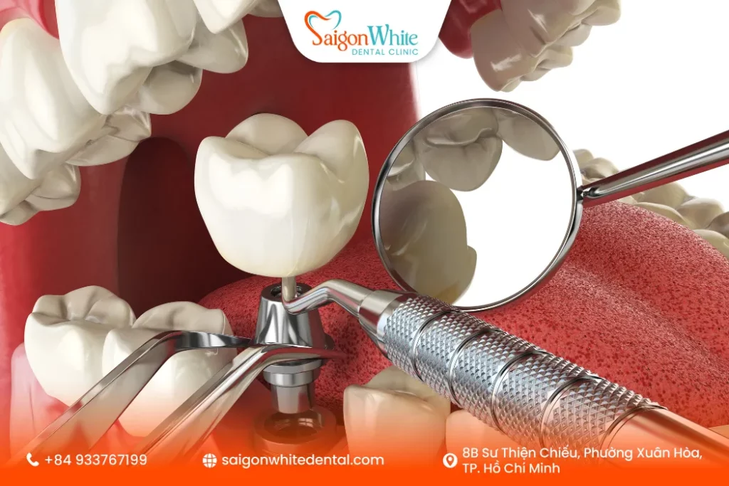 Yếu tố ảnh hưởng tới thời gian implant