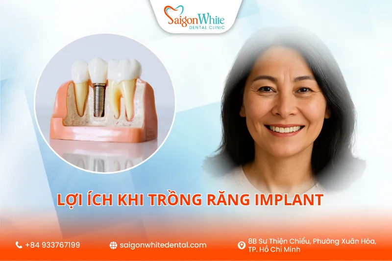 Lợi Ích Trồng Răng Implant Bạn Nên Biết