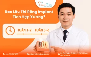 Bao Lâu Thì Răng Implant Tích Hợp Xương?