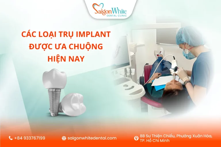 Các Loại Trụ Implant Được Ưa Chuộng Hiện Nay