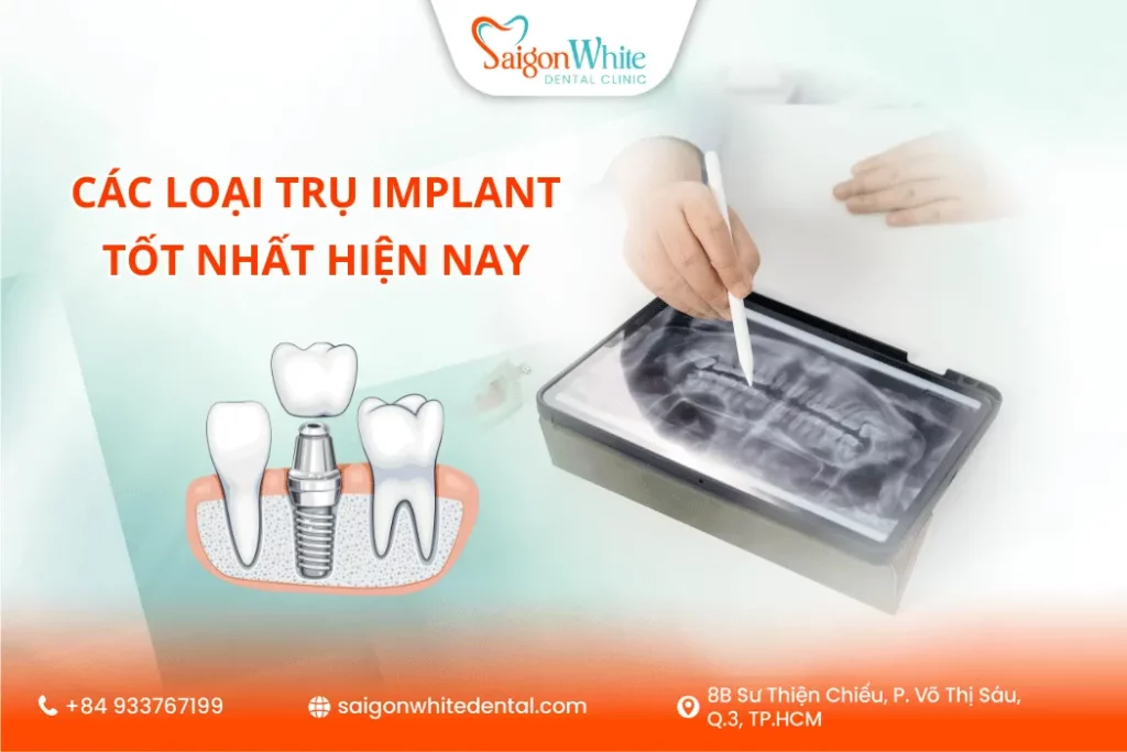 Các Loại Trụ Implant Tốt Nhất Hiện Nay