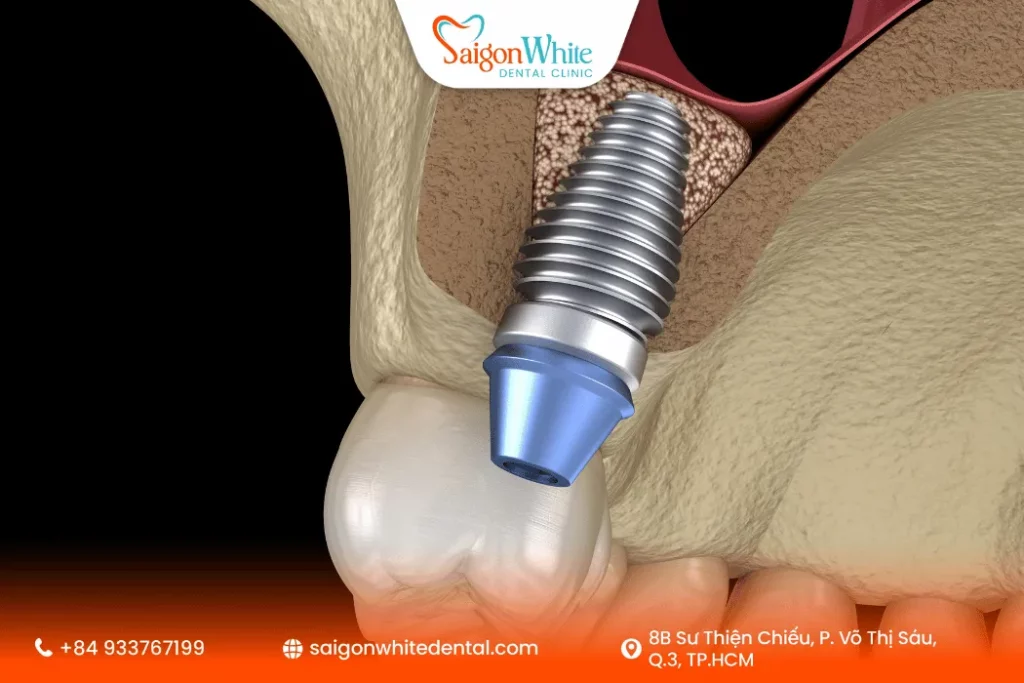 Những yếu tố ảnh hưởng đến việc lựa chọn trụ Implant