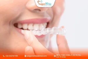 Những câu hỏi thường gặp khi niềng răng Invisalign