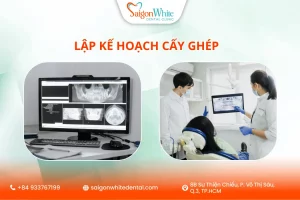 Lập kế hoạch trồng răng implant