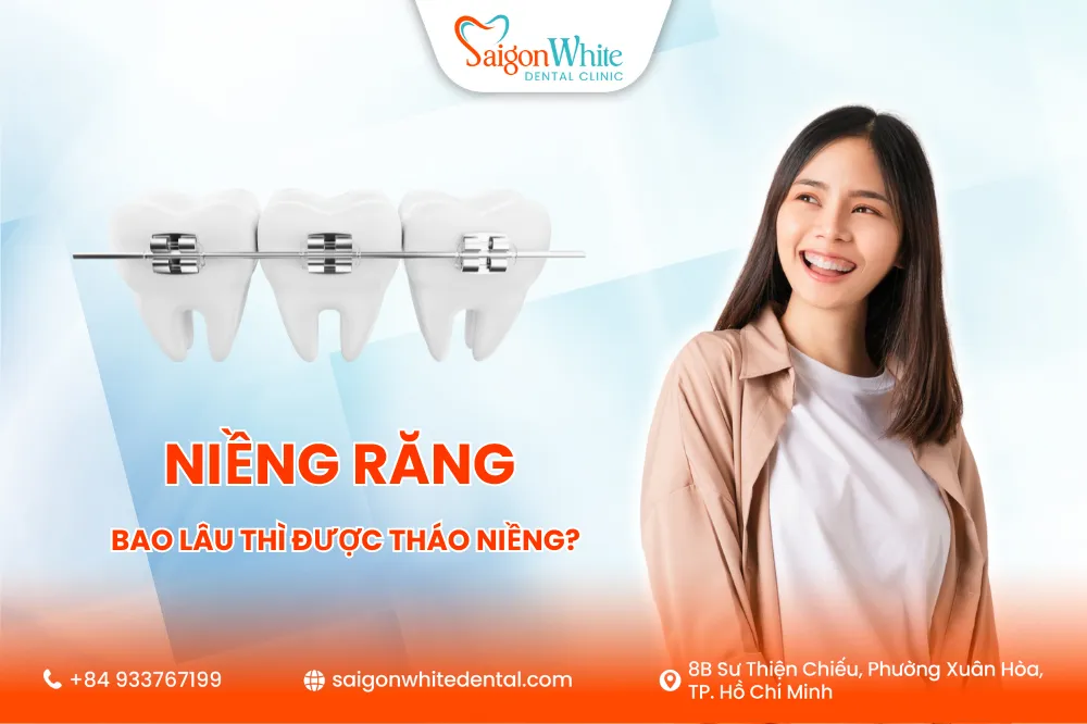 Niềng răng bao lâu thì được tháo ? 