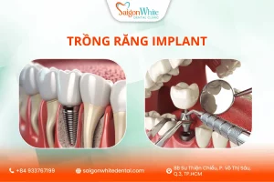 Trồng răng Implant là gì?