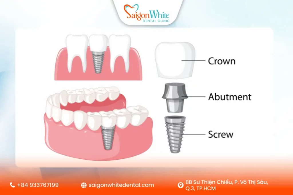 Trụ Implant là gì?