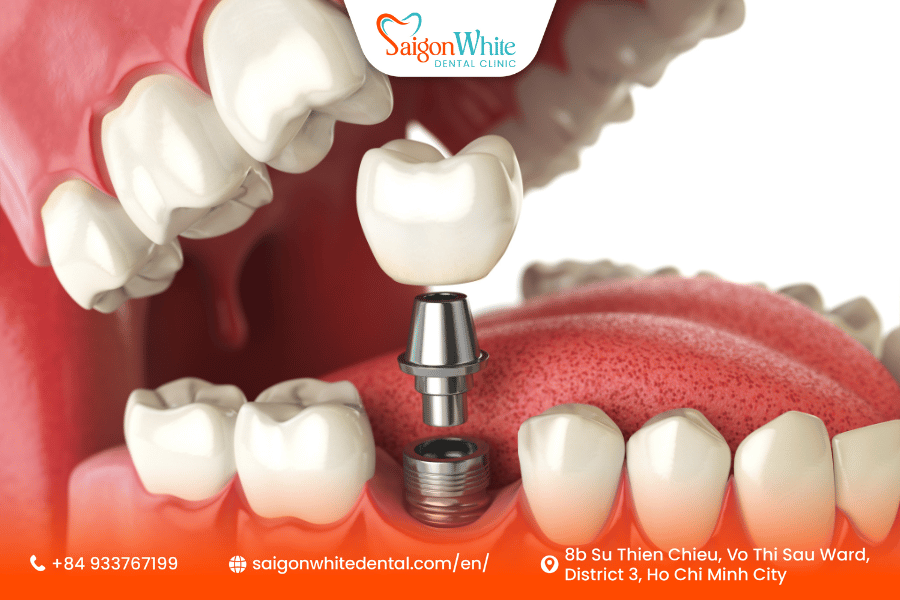 Dental Implants in Vietnam