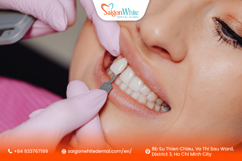 Dental Veneer