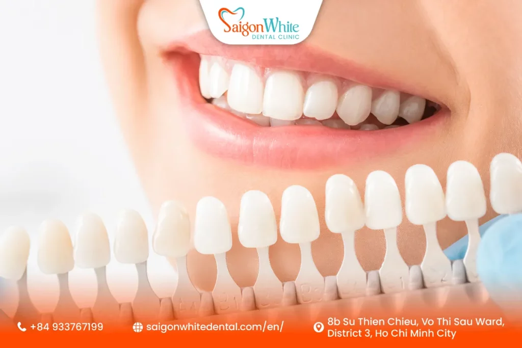 How the Veneer Process Works in Vietnam