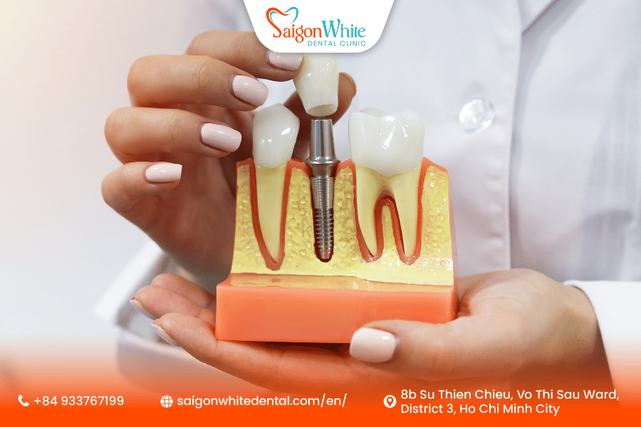 Single Tooth Implant