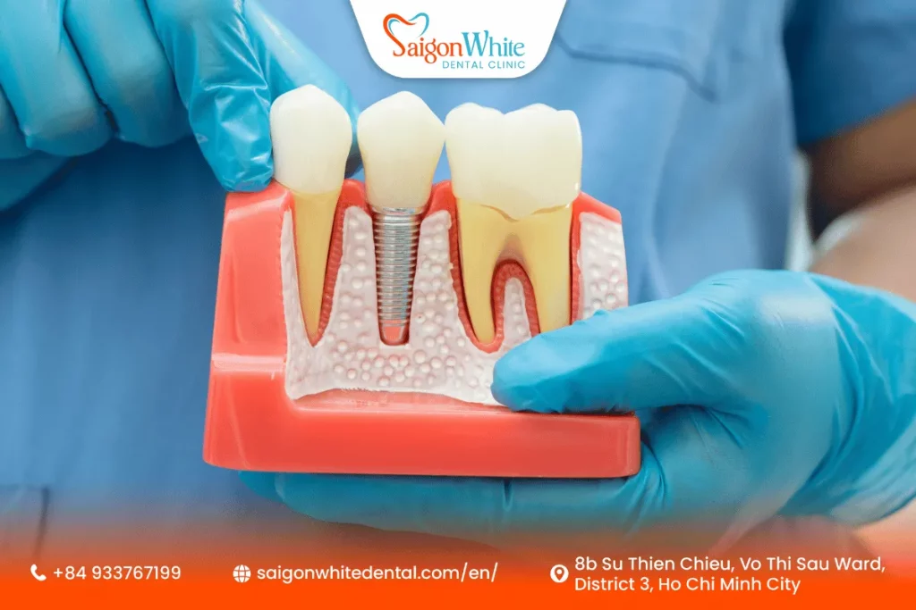 What Are Dental Implants?