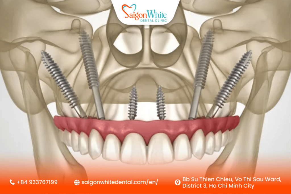 Zygomatic Implants