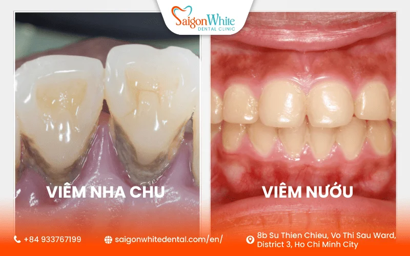 Phân biệt viêm nha chu và viêm nướu