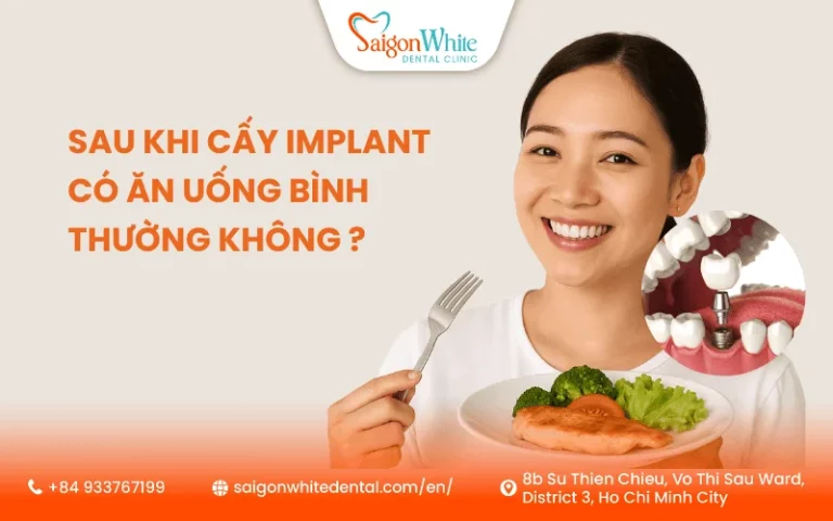 Sau Khi Cấy Implant Có Ăn Uống Bình Thường Không ?