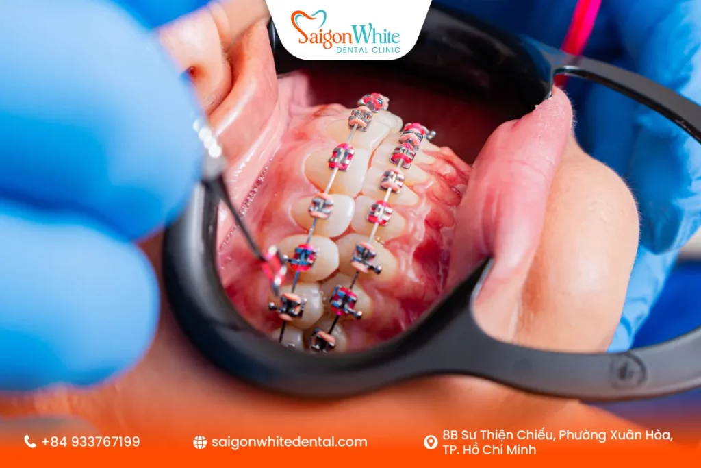 18 tuổi niềng răng được không?