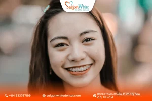Quy trình niềng răng ở tuổi 20 diễn ra thế nào?