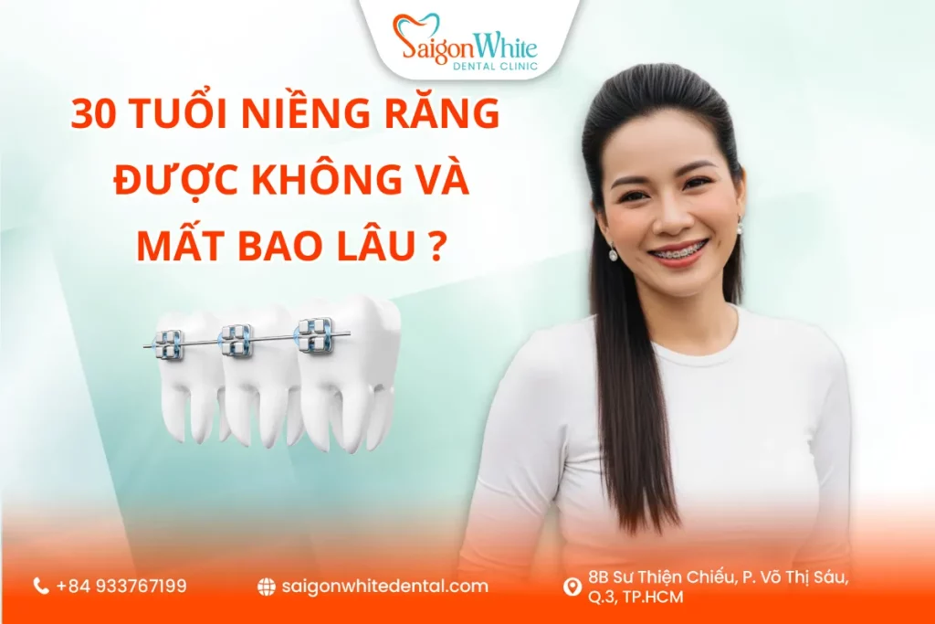 Trên 30 tuổi niềng răng được không và mất bao lâu