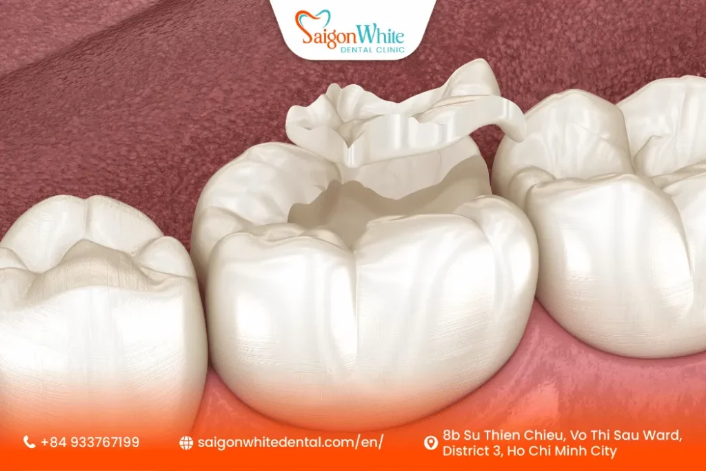 Types of tooth fillings available in Ho Chi Minh City
