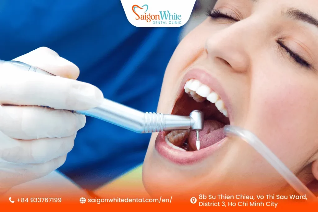 Why choose tooth fillings at Saigon White Dental?