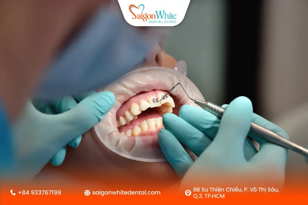 Niềng răng hô ở độ tuổi trưởng thành