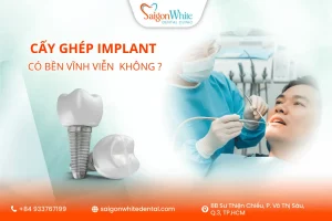 Cấy ghép Implant có bền vĩnh viễn như lời đồn?