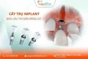 Cấy trụ Implant xong bao lâu thì gắn mão răng sứ lên được ?