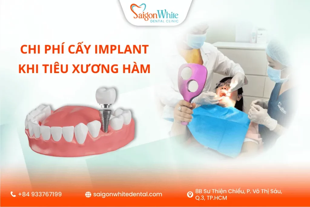 Chi phí cấy Implant khi tiêu xương hàm bao nhiêu là đủ?