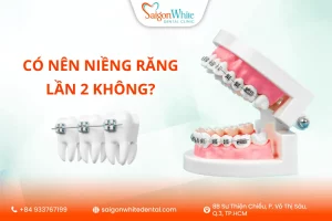 Có nên niềng răng lần 2 không?
