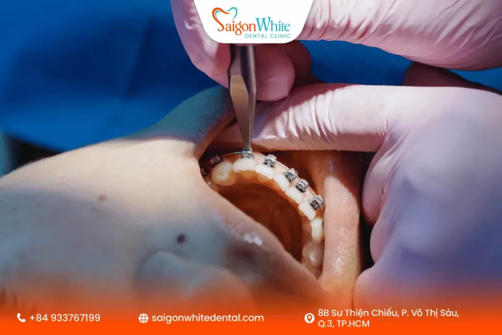 Niềng răng bao lâu thì siết một lần ?
