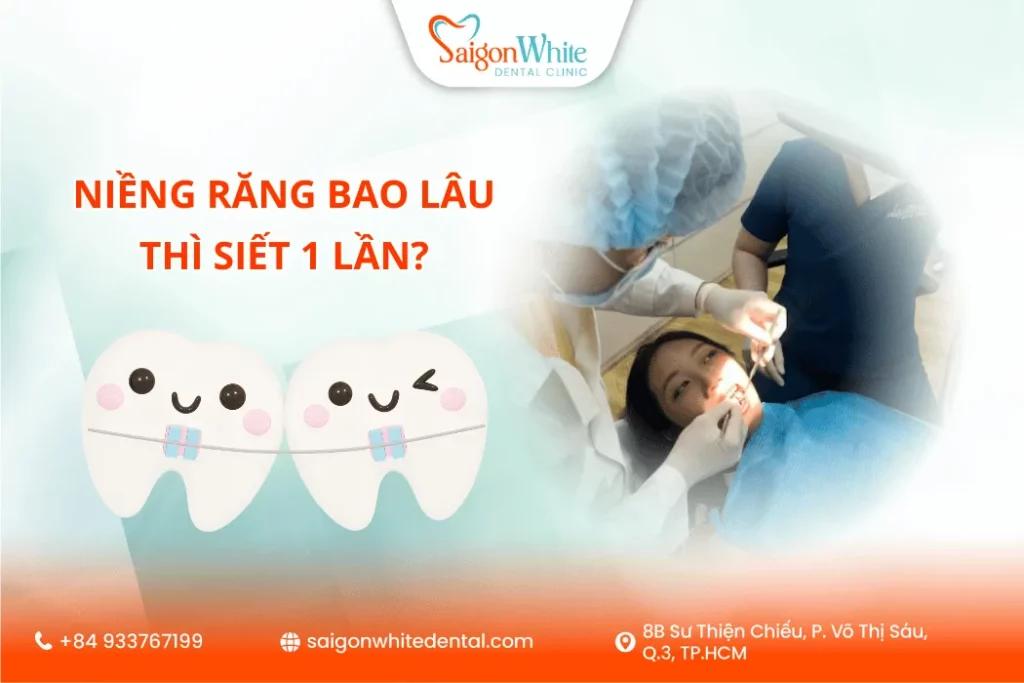 Niềng răng bao lâu thì siết 1 lần ? Bác sĩ giải đáp chi tiết