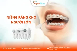 Niềng răng cho người lớn