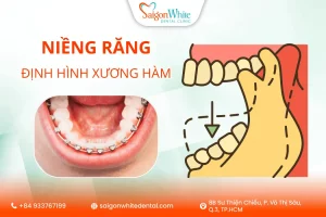 Can thiệp niềng răng sớm giúp định hình xương hàm