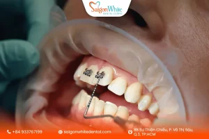 Niềng răng mắc cài có đau không?