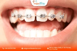 Đau khi niềng răng mắc cài là biểu hiện bình thường