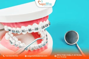 Cách giảm đau hiệu quả khi niềng răng mắc cài