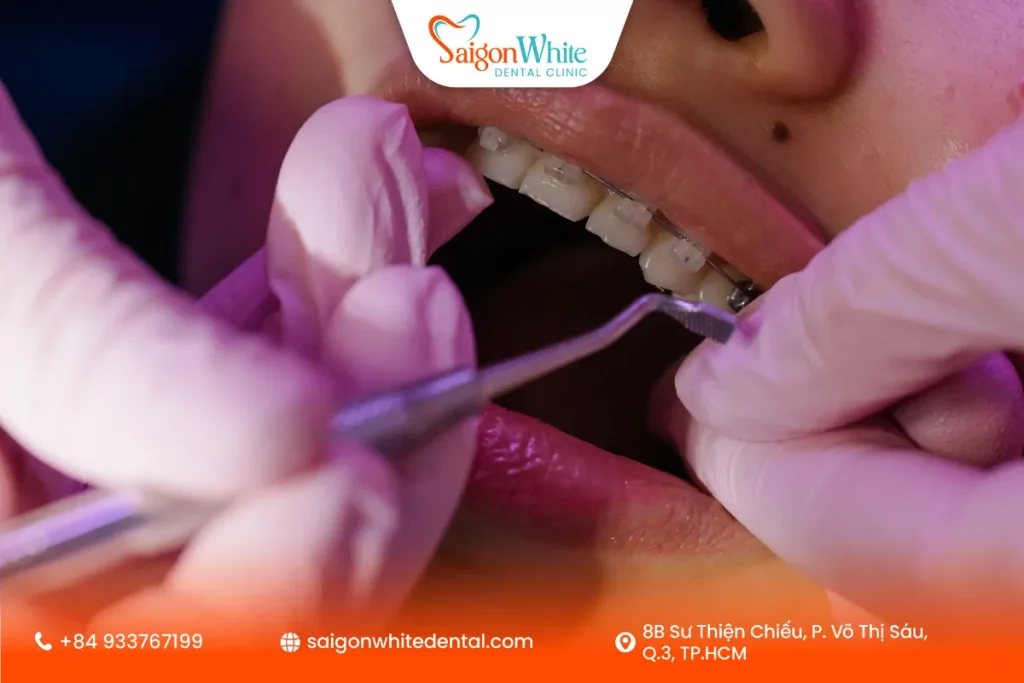 Niềng răng mắc cài sứ ở độ tuổi 30