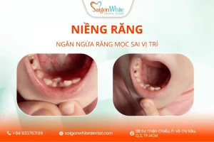 Niềng răng ngăn ngừa răng vĩnh viễn mọc sai vị trí