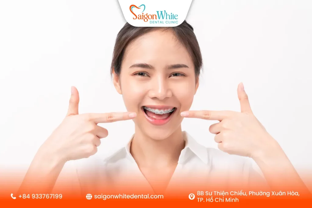 Phương pháp niềng răng tuổi 18