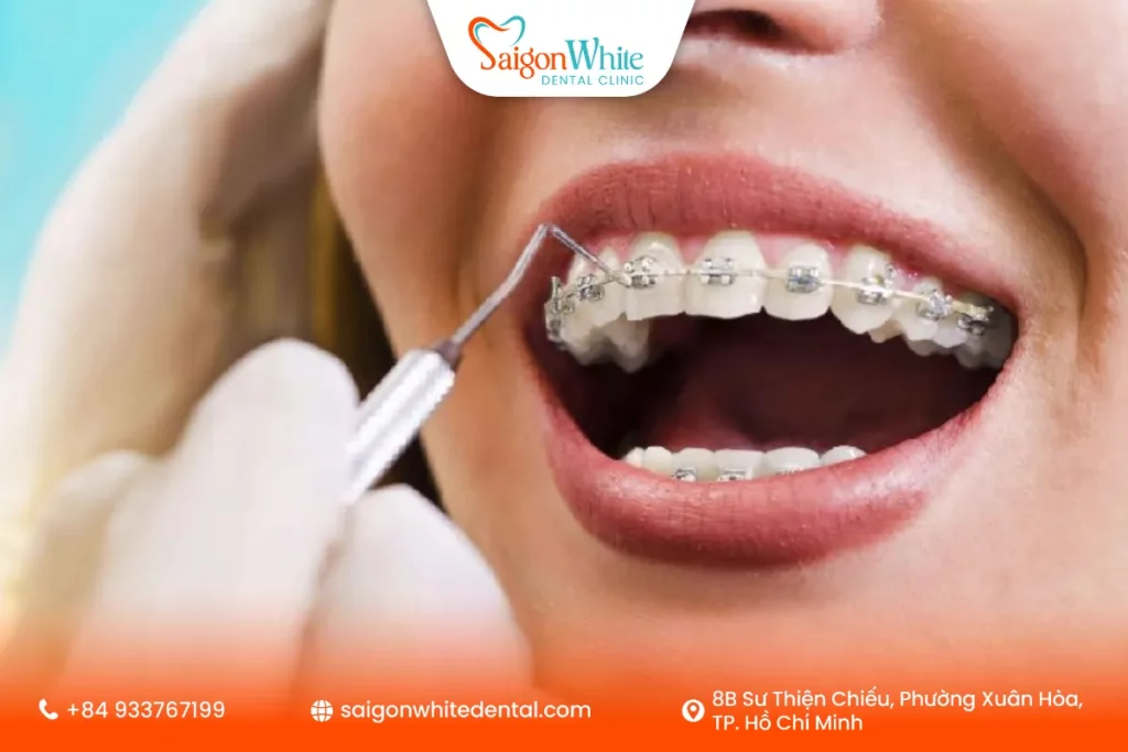 Quy trình niềng răng ở tuổi 20 diễn ra thế nào?